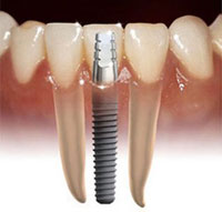 Tại sao cấy ghép răng(implant) là phương pháp ưu tiên? 