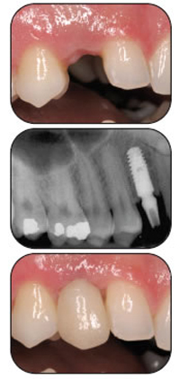 Cấy ghép Implant là gì ?