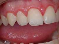 Mảng bám vi khuẩn gây bệnh nha chu là gì?
