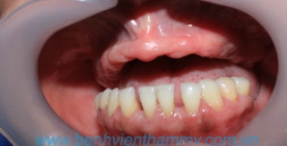 Phục hình trên implant (hàm phủ)