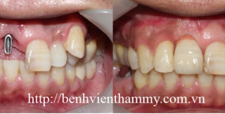 Cấy ghép răng implant 4