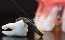 CÁC YẾU TỐ QUYẾT ĐỊNH ĐỐI VỚI CHỊU LỰC IMPLANT TỨC THÌ