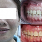 Răng nhiễm tertracycline - răng nanh ngầm - răng thưa 