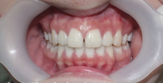Chỉnh hình răng thẩm mỹ điều trị răng thưa 1