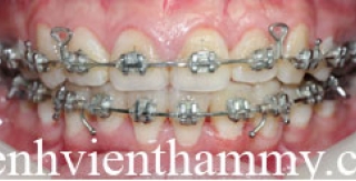 Chỉnh hình răng thẩm mỹ điều trị răng chen chúc với mắc cài kim loại 2