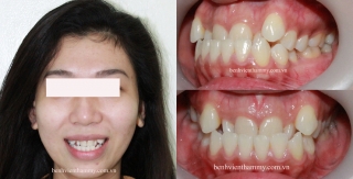 Điều trị răng móm – chen chúc - cắn chéo
