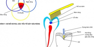 Phòng ngừa sâu răng bằng cách nào? 