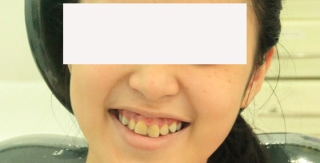 Cười hở nướu do răng ngắn