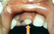 Xử trí chấn thương răng sữa 