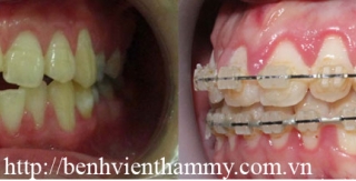 Chỉnh hình răng thẩm mỹ điều trị răng hô với mắc cài sứ