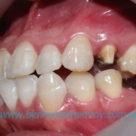 Răng sứ Ivoclar vivadent 13