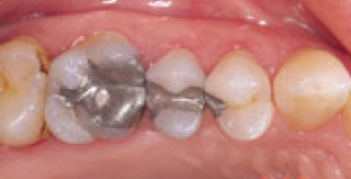 Trám răng bằng vật liệu trám Amalgam bền chắc nhưng kém thẫm mỹ