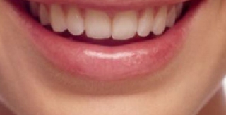 NHỮNG NGƯỜI KHÁC CÓ BIẾT TÔI ĐANG MANG  RĂNG CẤY GHÉP TRONG MIỆNG KHÔNG ?