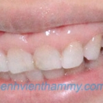 Răng sứ Emax Zircad - Ivoclar Vivadent 5