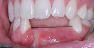 Mất răng nếu không được phục hồi ( làm răng giả ) sẽ đưa đến hậu quả gì ?