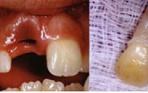 Những bước khẩn cấp để giữ lại răng bị rơi ra ngoài xương ổ