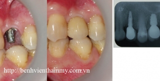 Cấy ghép răng implant 6