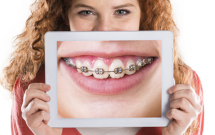Chỉnh răng thẩm mỹ răng hô kèm cắn sâu