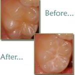 Trám bít hố rãnh bằng sealant ở trẻ em là gì ? 