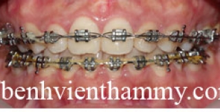 Chỉnh hình răng thẩm mỹ điều trị răng thưa và hô với mắc cài kim loại