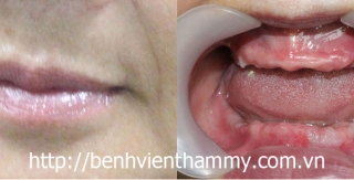 Cấy ghép răng implant 8