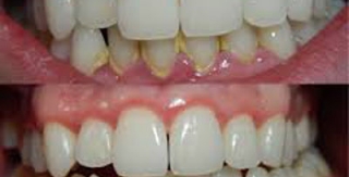 Dị ứng và viêm nướu