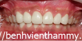 Răng sứ Emax Zircad - Ivoclar Vivadent - Thụy Sỹ 22