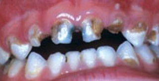 Trẻ Em Bị Sâu Răng Tăng Cao Nguy Cơ Mập Phì