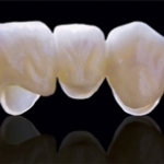 Hệ thống sứ Cercon thông minh 
