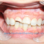 Răng sứ Emax Zircad - Ivoclar Vivadent