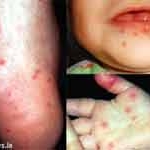 CHĂM SÓC TRẺ BỆNH TAY CHÂN MIỆNG 