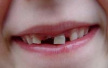 Chăm sóc răng miệng khẩn cấp cho bé