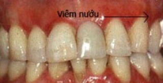 Viêm nướu răng ở trẻ em