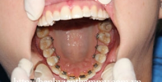 Chỉnh hình răng thẩm mỹ điều trị với mắc cài mặt lưỡi