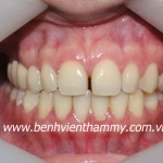 Chỉnh nha thẩm mỹ 1