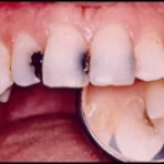 Với vi khuẩn: Có thể chủng ngừa để diệt con streptococcus mutans hay không? 