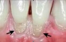 Phòng và điều trị mòn răng