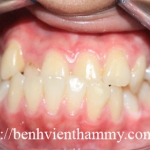 Chỉnh hình răng thẩm mỹ điều trị răng móm