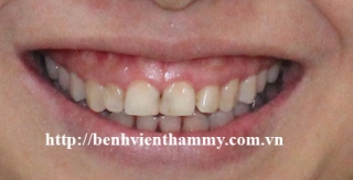 Răng sứ Emax Zircad - Ivoclar Vivadent 12
