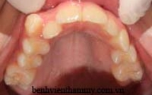 CHỈNH NHA HIỆN ĐẠI: HẠN CHẾ NHỔ RĂNG