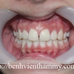 Chỉnh hình răng thẩm mỹ điều trị răng thưa 1