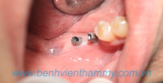 Phục hình implant 2 implant