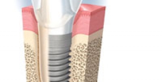 HỆ THỐNG IMPLANT NOBEL BIOCARE TẠI AVA