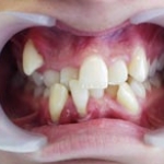 Mối liên quan giữa lệch lạc khớp cắn và dịch vụ Niềng răng?