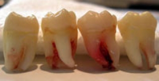 Răng khôn 
