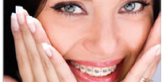 Bí quyết vệ sinh răng miệng khi nắn chỉnh răng