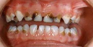 CHẾ ĐỘ ĂN VÀ SÂU RĂNG