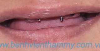 Implant cố định toàn hàm