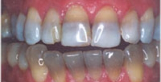 Răng nhiễm sắc tố vàng, nâu hay đen. Cách chữa trị. 