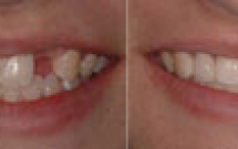 Chịu lực tức thì trên Implant là gì?
